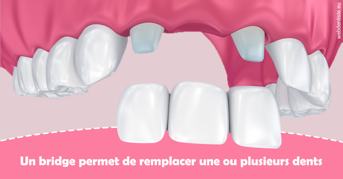 https://www.dr-bonan-stephanie.fr/Bridge remplacer dents 2