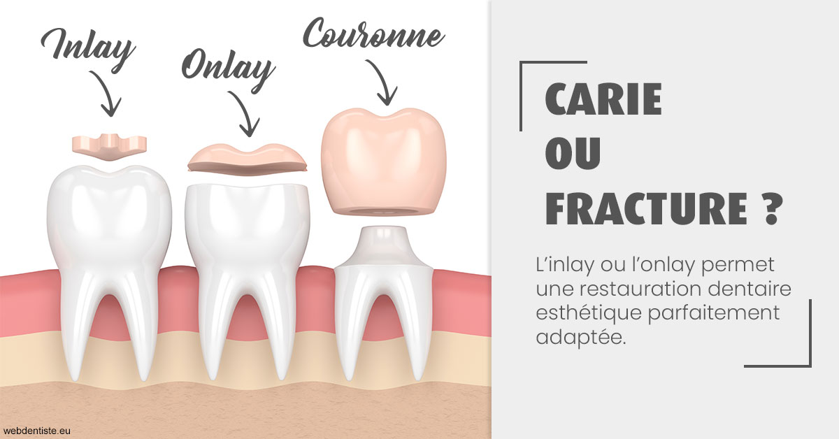https://www.dr-bonan-stephanie.fr/T2 2023 - Carie ou fracture 1