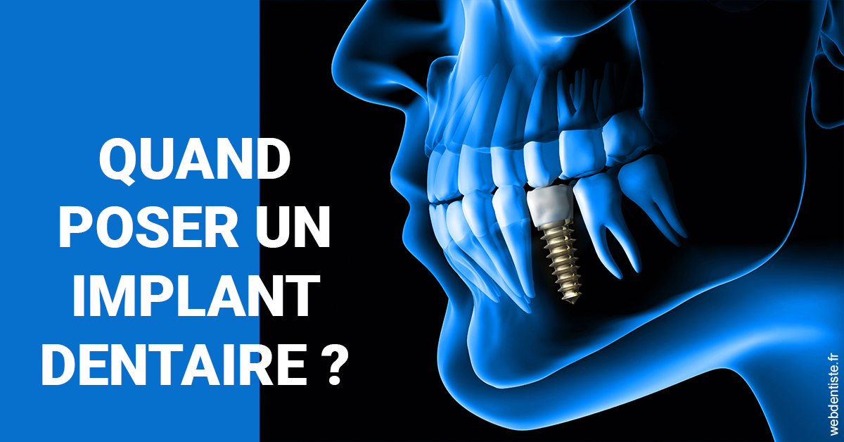 https://www.dr-bonan-stephanie.fr/Les implants 1