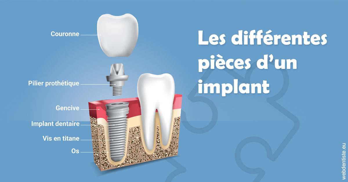 https://www.dr-bonan-stephanie.fr/Les différentes pièces d’un implant 1